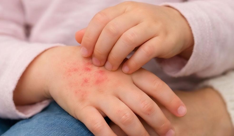 a child with scabies itching red and sore skin on her hand picture of a child with scabies itching red and sore skin on her hand