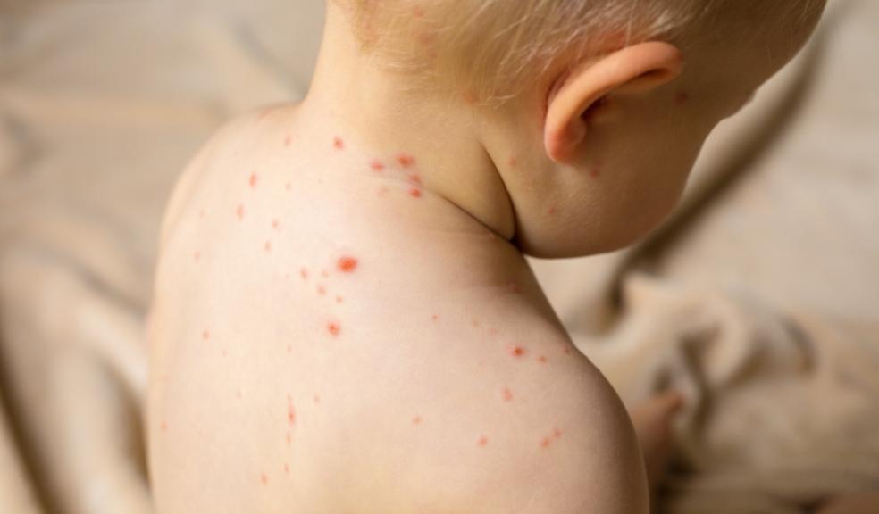 picture of a child with a rash