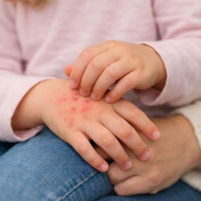 picture of a child with scabies itching red and sore skin on her hand