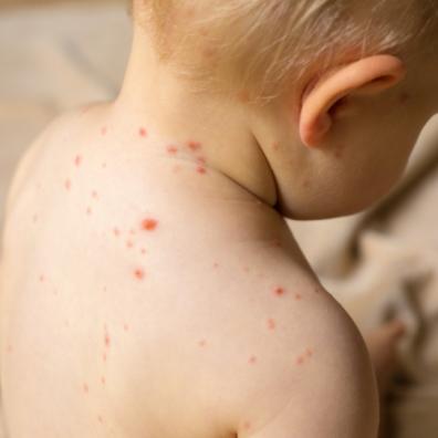picture of a child with a rash